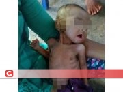 Ada Gizi Buruk di “Kediaman” Bupati Halsel
