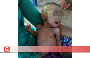 Ada Gizi Buruk di “Kediaman” Bupati Halsel